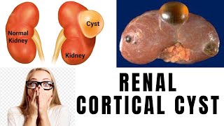 Kidneys Cysts Diagnose and Treatment  Renal Cyst  Kidneys Gathan [upl. by Merriam]