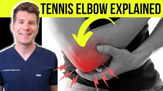 Doctor explains TENNIS ELBOW lateral epicondylitis  Symptoms causes amp treatment [upl. by Deb]