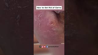 How to Get Rid of Corns on the Side of Your Foot By Foot Specialist Miss Foot Fixer [upl. by Anilec466]