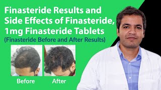 Finasteride Results and Finasteride Side Effects  Finasteride 1mg Tablets Before and After Results [upl. by Linnette]