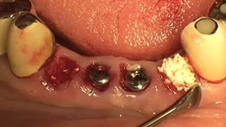 Socket preservation using alloplastic graft material OSTEON™ [upl. by Syramad617]