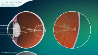 Spherical Aberration Explained  PureVision2 [upl. by Kravits]