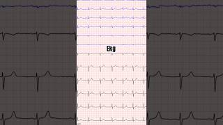 Whats cause your skipped beats ekg rhythm [upl. by Idnahc]