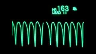 Arrêt cardiaque sur IDM monitorage ECG [upl. by Lynnworth]