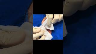 A Quick Little Cyst [upl. by Elletnahc]