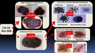 Seborrheic Keratosislike melanomas  Dr Cristina Carrera [upl. by Olimpia]