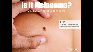 Is it melanoma [upl. by Akcir896]