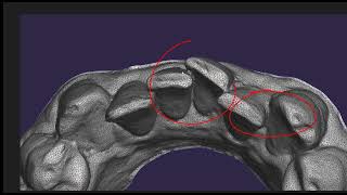 Intra Oral Scanning segmentation and its influence on Interproximal reduction for aligner treatment [upl. by Rochella67]