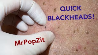 Quick and easy blackhead extractions Imbedded plugs removed with ease [upl. by Sillyrama]