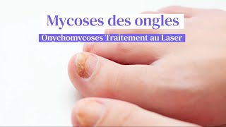 Mycoses des ongles  Traitement au laser chez Skin Marceau à Paris [upl. by Rednaeel139]