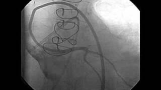 Left Ventricular Dysfunction after Heart Transplantation [upl. by Pozzy530]