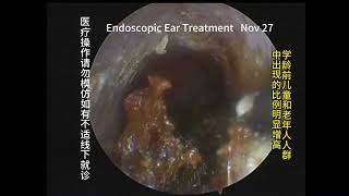 During physical examination it was found that there was cerumen embolism in both ears 20231127 [upl. by Hgielanna]