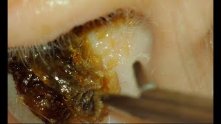 EAR WAX REMOVAL  MASSIVE PLUG  CAUSED HEARING LOSS [upl. by Oicaro517]