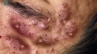 Big Cystic Acne Blackheads Extraction Blackheads amp Milia Whiteheads Removal Pimple Popping [upl. by Elleynod]