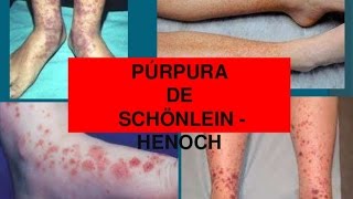 Purpura de Henoch schonlein  conferencia pediatria [upl. by Lenard147]