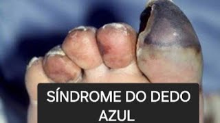 🚨 SÍNDROME DO DEDO AZUL [upl. by Durer292]