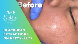 Blackhead Extractions on Netty  11th Treatment [upl. by Aguste]