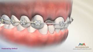 Orthodontic amp Restorative Treatment for Missing Lateral Incisor  Different Options [upl. by Rimma]