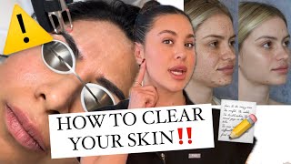 How To Get GLASS SKIN microneedling vs laser which is better for you [upl. by Massiw]