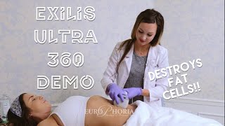 EXILIS ULTRA DEMONSTRATION BODY  Exilis Ultra 360 Experience at EuroPhoria [upl. by Beedon]