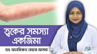 Skin eczema treatment  Eczema treatment bangla  একজিমা রোগের চিকিৎসা  Health Tips Bangla [upl. by Lennon285]