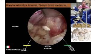 SPINE WEBINAR 76 REHERNIACIONES DISCALES ¿NECESITAMOS FUSIONAR ACTUALMENTE [upl. by Loma670]