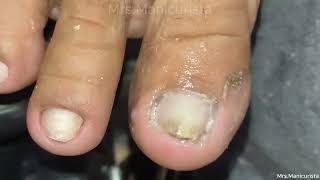 Toenail Ingrown Removalsulit sa dami ng Dry skin [upl. by Shina]