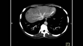 Abdomen Liver Cavernous Hemangioma of the Liver9 of 9 [upl. by Tristan133]