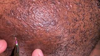 Ingrown Facial Hair Removal Pt1 [upl. by Subak]