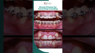 Braces Process for Correcting Crowding [upl. by Marvella]