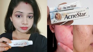 My honest review Acne star gel  My journey with Acne star gel [upl. by Atinit]