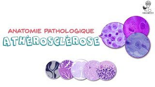 Anatomie Pathologique  Athérosclérose [upl. by Oicnedif]