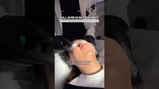 FULL Acne Scar Treatment for Ice Pick  Boxcar Scars with Dr Qazi  Part One Diagnosing the Scars [upl. by Kendricks261]