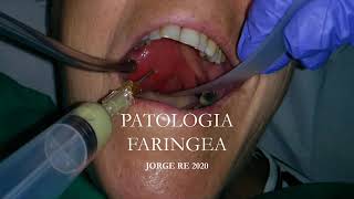 PATOLOGIA FARINGEA Faringoamigdalitis Absceso profundo de cuello APNEA DEL SUEÑO [upl. by Anyahc]