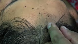 Head Lice amp Nits Picking and Popping with Nails [upl. by Gussy]