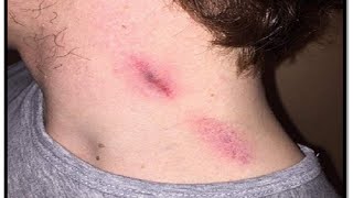 How to get rid of hickey on neck chest lips fast overnight [upl. by Mulcahy]