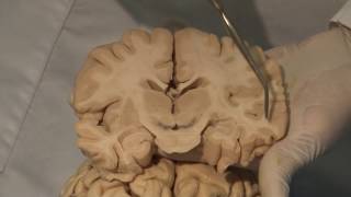 Cortical Localization Neuroanatomy Video Lab  Brain Dissections [upl. by Seraphina]