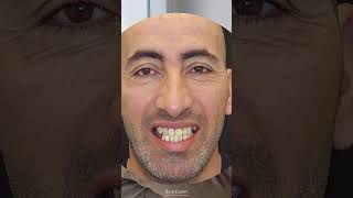 DENTISTE EN TURQUIE  🦷 Témoignage de Faouzi  3 implants dentaires  24 couronnes Emax  BODYEXPERT [upl. by Eilema]