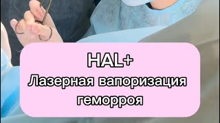 Halлазерная вапоризация геморроя дезартеризация под контролем узи [upl. by Janifer845]