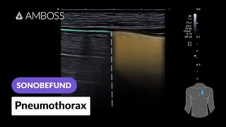 Sonobefund Pneumothorax  AMBOSS [upl. by Sylas]