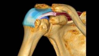 Supraspinatus Pathology [upl. by Eceertal]