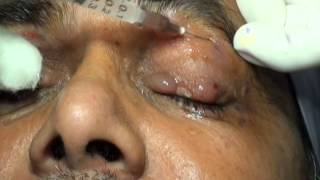 Botulinum Toxin Injection for Blepharospasm and Hemifacial Spasm Drs Vidushi Suresh Pandey SuVi Eye [upl. by Ayela883]