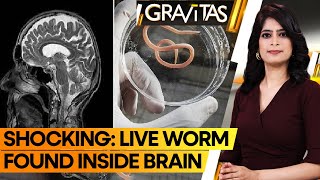 Gravitas Brain Worm Nightmare Doctors Pull Live Parasite from Patients Brain [upl. by Gosnell978]