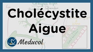 Cholécystite aiguë inflammation vésicule biliaire symptômes colique biliaire et cholécystectomie [upl. by Tallula]