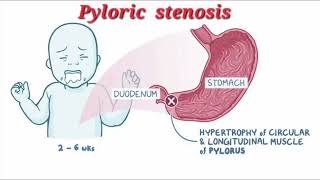 Pyloric stenosis mrcpch Video station [upl. by Kawasaki509]