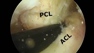 Mucoid Degeneration of Anterior Cruciate Ligament—A Systematic Approach for Debulking [upl. by Retsila796]