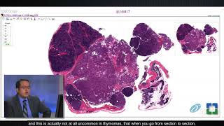 Pathology Insights Basics of Thymic Pathology with Sanjay Mukhopadhyay MD [upl. by Oliver]