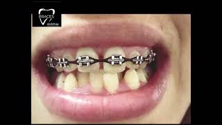 BIMAXILLARY PROTRUSION  BRACES 917006740026 anantnag dentistry health aestheticsyoutube trend [upl. by Hefter135]