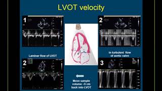 Guidelinebased Webinar on the Echo Assessment of Aortic Valve Stenosis [upl. by Grady]