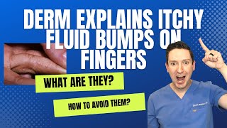 Do you have ITCHY FLUID LITTLE BUMPS on your HANDS OR FEET Derm explains Dyshidrotic Eczema [upl. by Qifar]